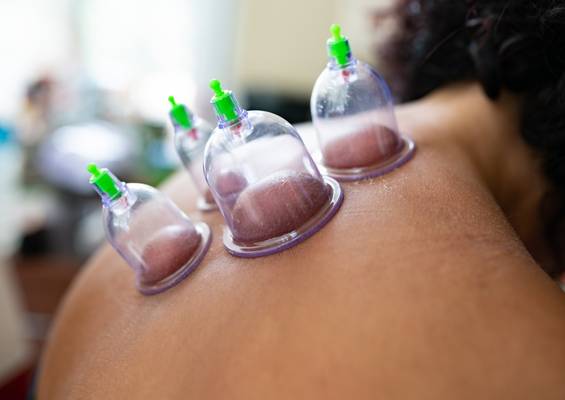 cupping adelaide